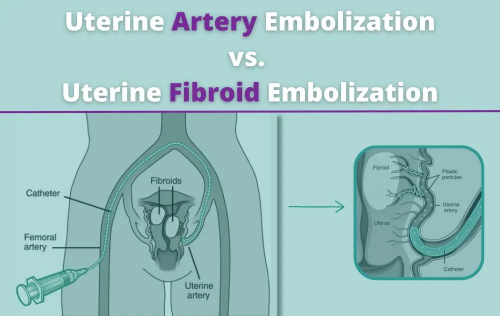 Uterine artery embolization is a minimally invasive procedure used to treat uterine fibroids by blocking the blood supply, providing a safe and effective alternative to surgery.